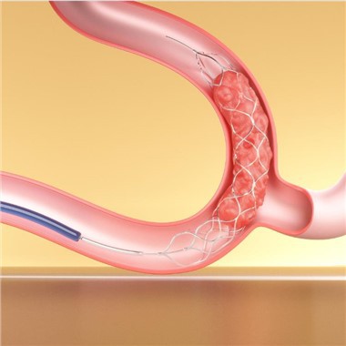 Perangkat Trombektomi Stent Retriever